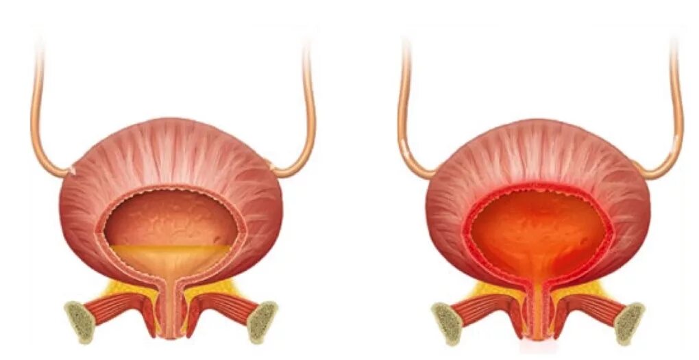 Заболевание цистит болезнь. Цистит воспаление мочевого пузыря. Цистит мочевого пузыря у женщин. Мочевой пузырь при цистите.