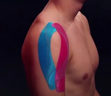 Тейпы при растяжении плеча