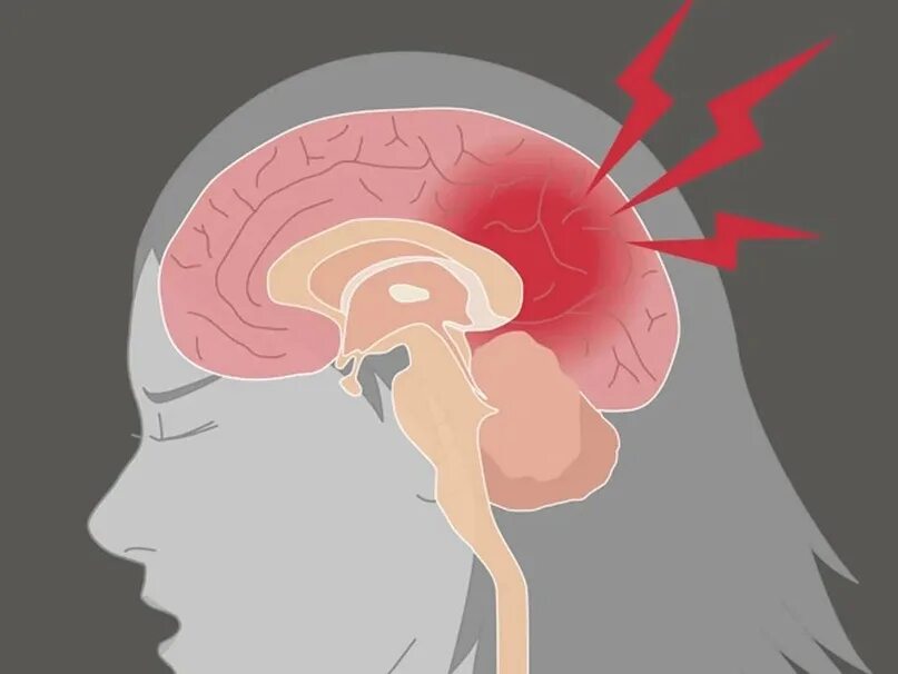 Головная боль иллюстрация. Повреждение головного мозга. Сотрясение мозга механизм. Сотрясение 6