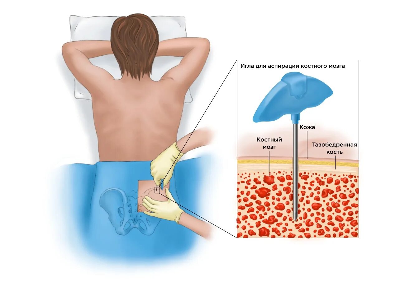 Костный мозг жидкость. Трепанобиопсии костного мозга. Игла для взятия пункции костного мозга. Аспирация костного мозга.