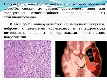 Зоны инсульта
