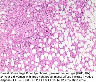 Lymphoma