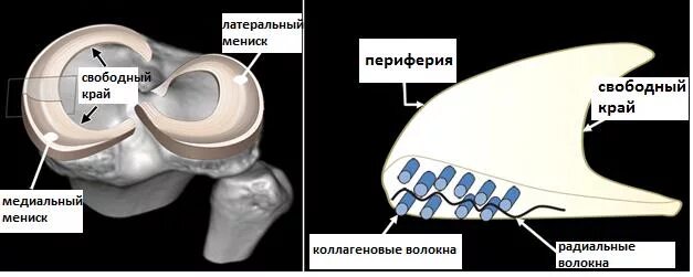 Экструзия внутреннего мениска коленного сустава что это. Повреждение медиального мениска Stoller 1. Экструзия латерального мениска. Разрыв рога латерального мениска.