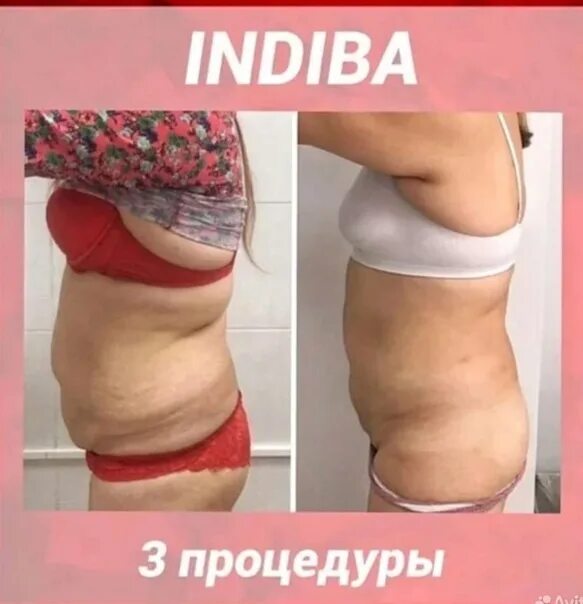 Индиба аппарат отзывы. Indiba аппарат. RF - лифтинг indiba.