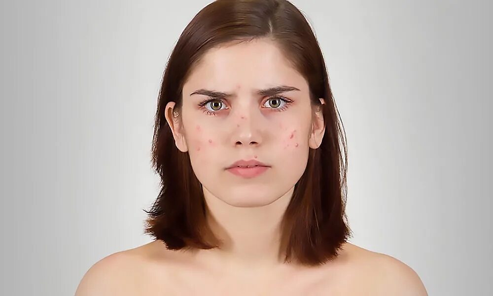 Ироничное лицо. Лицо девушки с проблемной кожей. Портрет девушки с проблемной кожей.