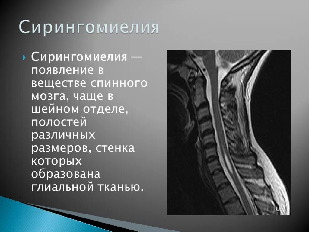 Жидкость в спинном канале. Сирингомиелия и Сирингобульбия. Сирингомиелия миелография. 10. Сирингомиелия. Сирингомиелия грудного отдела позвоночника.