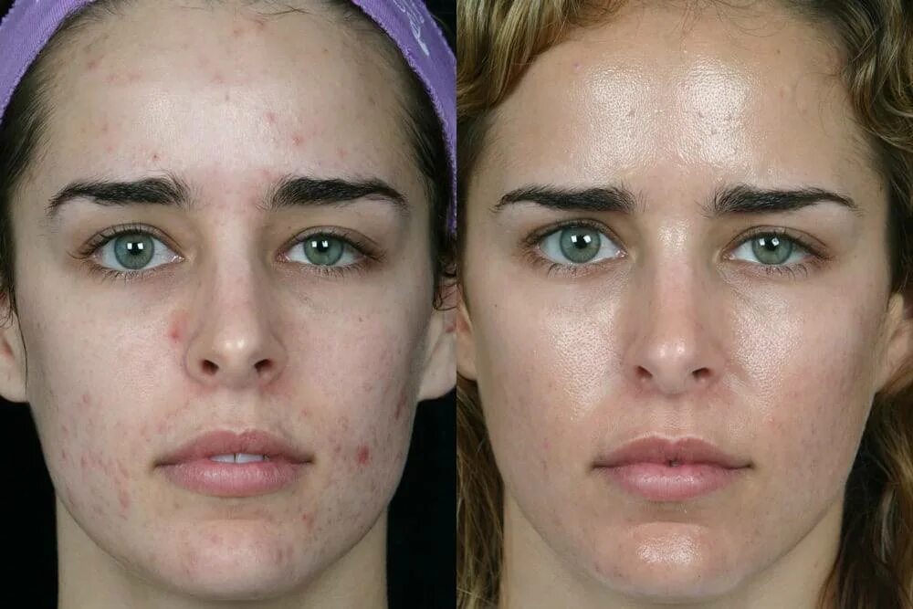 Дезинкрустация (гальваническая чистка лица). Кожа до и после косметолога. Механическая чистки лица жо и после.