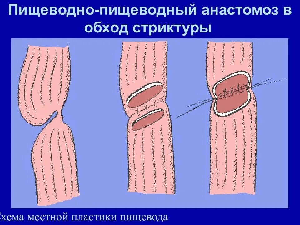 Анастомоз пищевода. Пищеводно желудочный анастомоз схема. Пищеводно-кишечный анастомоз. Местная пластика пищевода. Пищеводно-кишечный анастомоз по Давыдову.