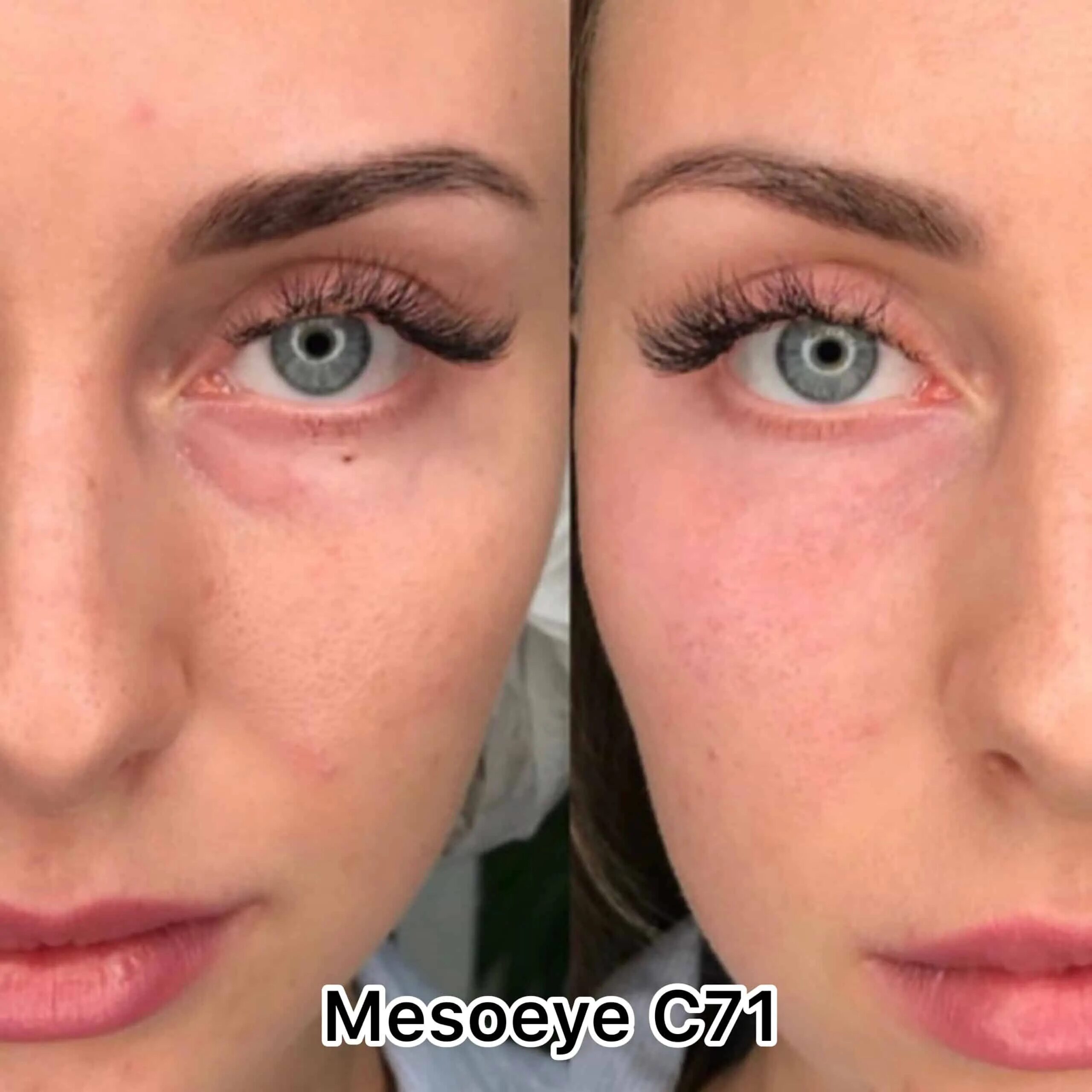 Мезоай цена. Биоревитализация МЕЗОАЙ. MESOEYE c71 до и после. Мезотерапия глаз до и после. Мезотерапия под глазами до и после.