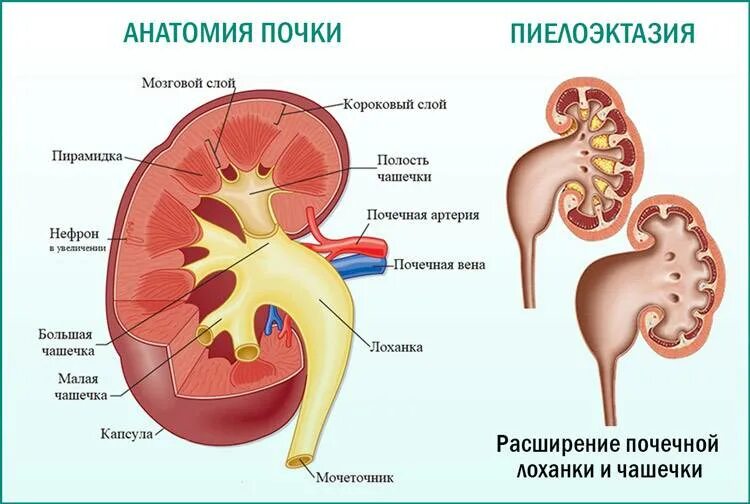 Пиелоэктазия слева лоханка 11мм. Почечная лоханка строение анатомия. Расширение лоханки почки пиелоэктазия. Строение почки почечная лоханка. Почему лоханка