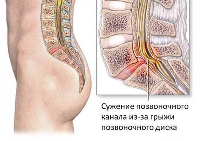 Можно вылечить стеноз. Стеноз позвоночного канала l4-l5. дегенеративный спинальный стеноз l3-l4. абсолютный стеноз позвоночного канала l3-l4. стеноз позвоночного канала с4 с5.