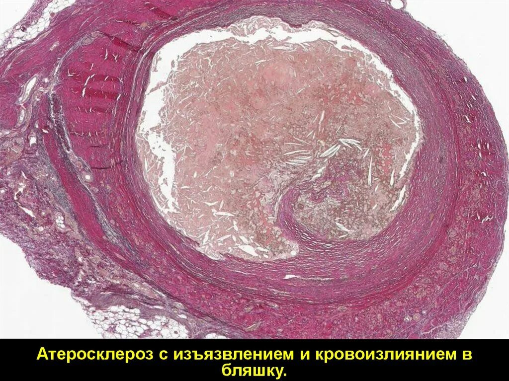 Атеросклероз коронарных артерий патанатомия. Атеросклероз аорты гистология. Атеросклероз аорты патанатомия.