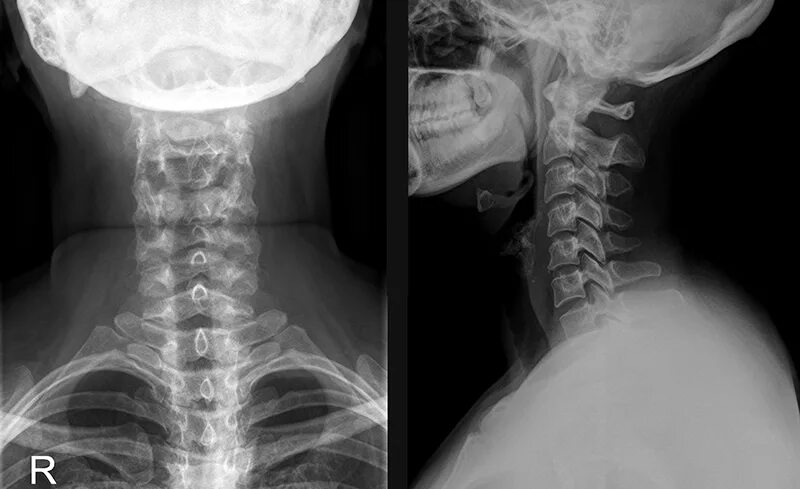 Шейный отдел позвоночника диагнозы. Шейный отделтпозвоночника рентген. Шейный отдельпозвоночнмка рентген. Рентген шейного отдела позвоночника с функциональными пробами. Рентген шейного отдела норма.