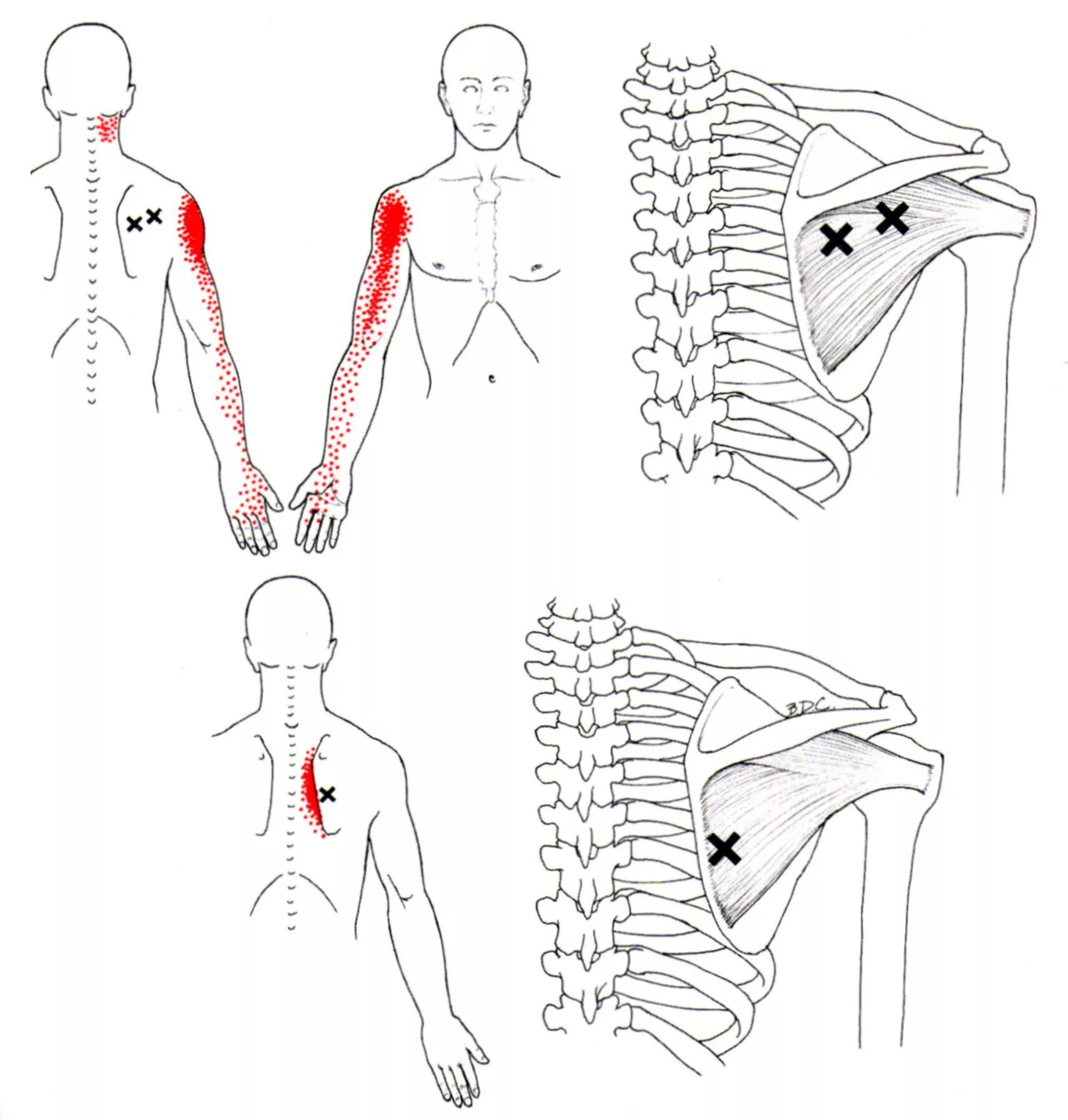 Иррадиация поясницы. Подостная мышца триггерные точки. Надостная мышца триггерные точки. Триггерные точки ромбовидной мышцы. Подостная мышца плеча триггерные точки.
