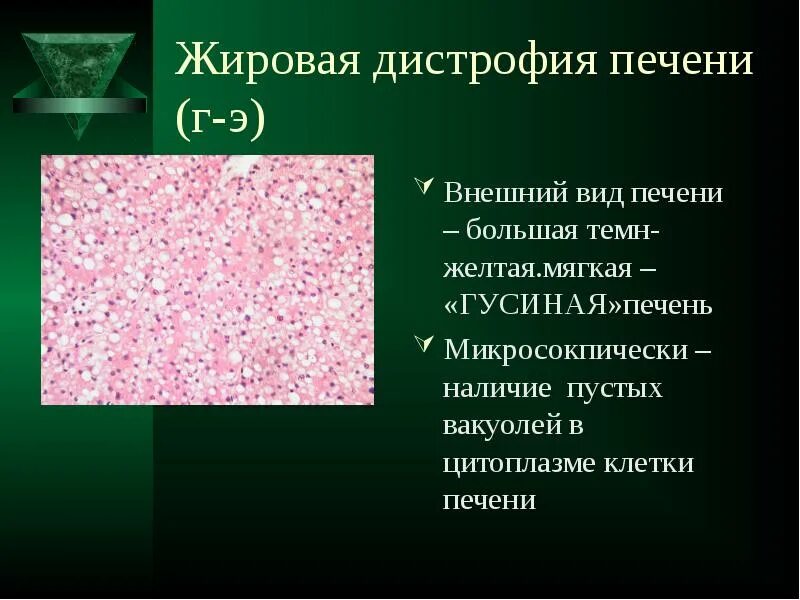 Гусиная печень вид дистрофии. Гусиная печень жировая дистрофия. Дистрофия презентация. Минеральная дистрофия презентация.