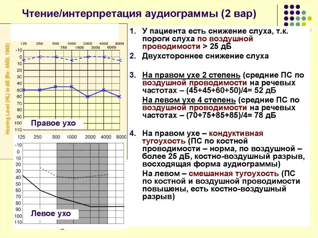 Возрастная норма слуха на аудиограмме. Аудиограмма расшифровка норма. Аудиограмма слуха норма отклонения. Расшифровка аудиометрии слуха норма. Сенсоневральная тугоухость код мкб