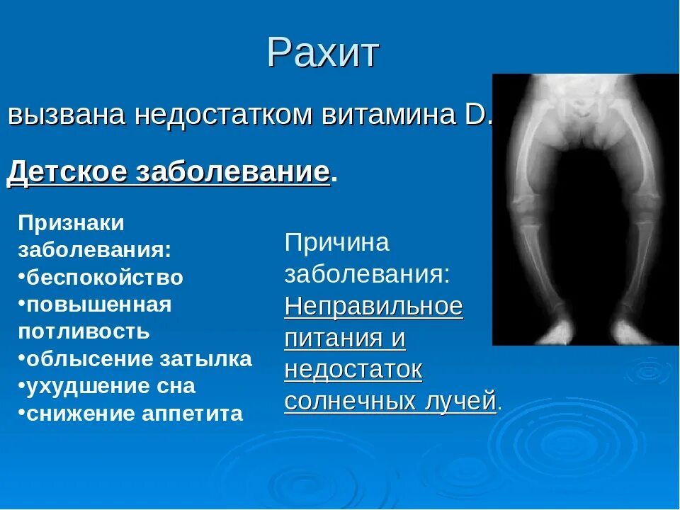 Болезни при нехватке витамина д. Недостаток витамина д вызывает заболевание. Рахит нехватка витамина. Болезни при недостатке витамина d. Рахит вызывает недостаток витамина