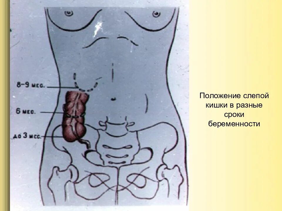 Расположение червеобразного отростка у беременных. Расположение аппендикса у беременных. Слепая кишка с аппендиксом. Острый аппендицит у беременных