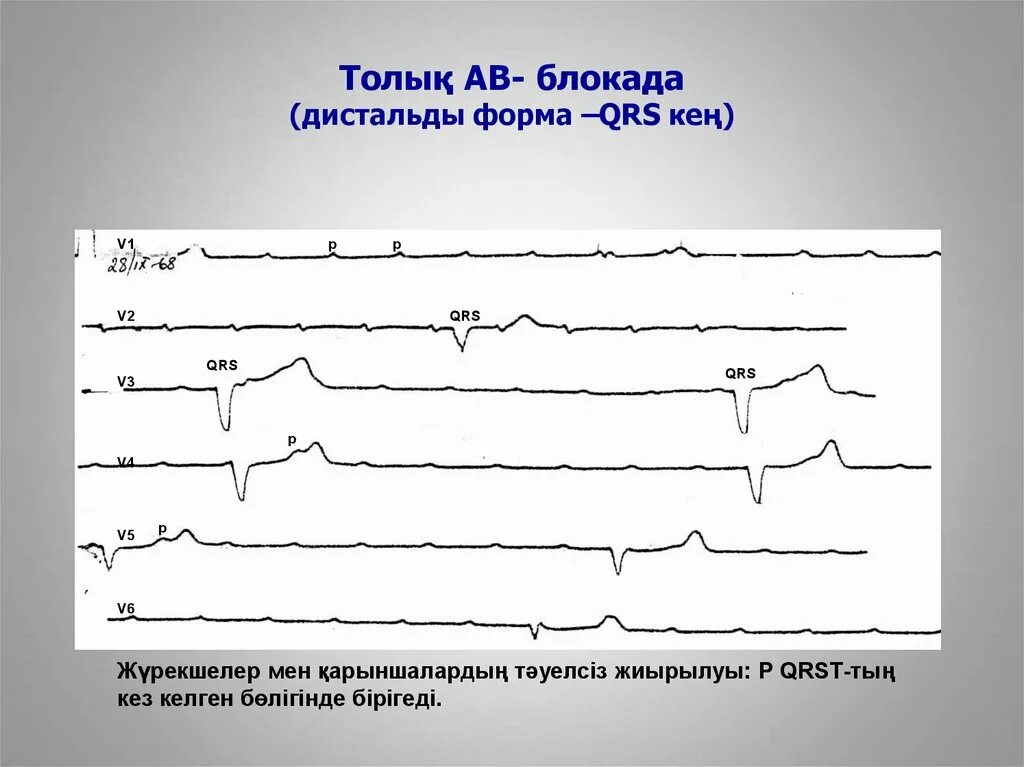 Блокада qrs. Прогрессирующая АВ блокада 2 степени. Артериове5трикулярная блокада 3 ст. Форма QRS. Полная АВ блокада на пленке.