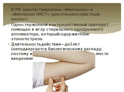 Имплант импланон нкст отзывы