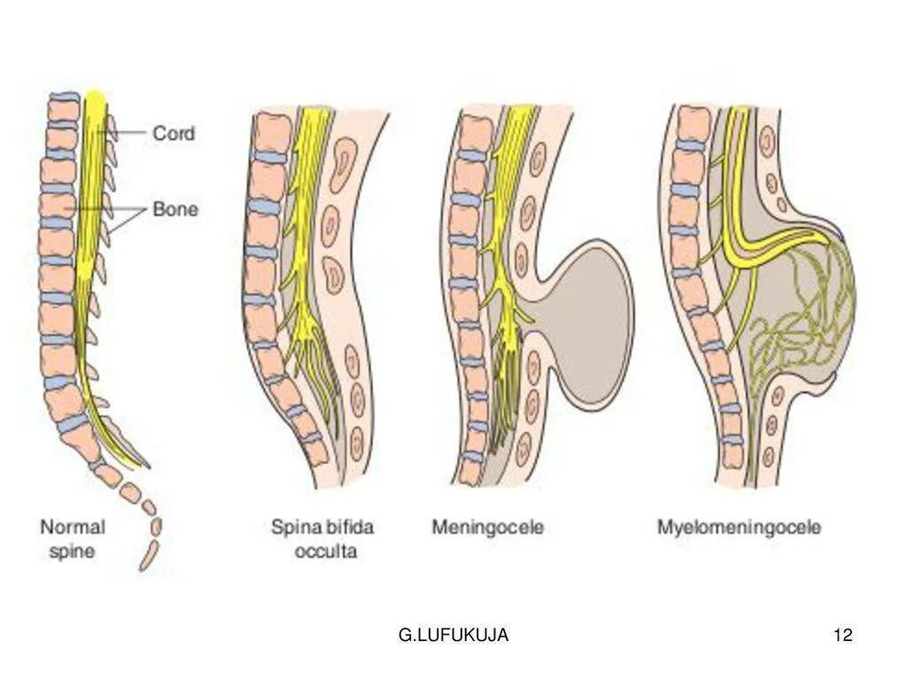 Расщепление латынь. Спинномозговая грыжа spina Bifida. Грыжа спинного мозга спина бифида. Спинальный дизрафизм (спина бифида). Менингоцеле пояснично-крестцового.