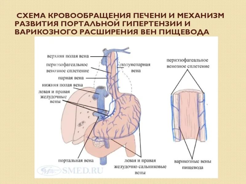 Портальная гипертензия анастомозы печени. Механизм развития портальной гипертензии схема. Воротная Вена при портальной гипертензии. Схема воротной вен печени. Печень расширены вены