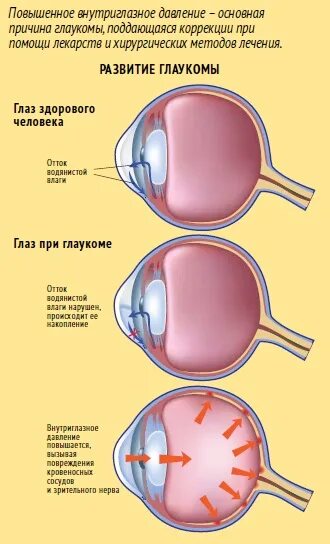 Глаукома памятка. Памятка для больных глаукомой. Зрение при глаукоме. Внутриглазное давление при глаукоме.