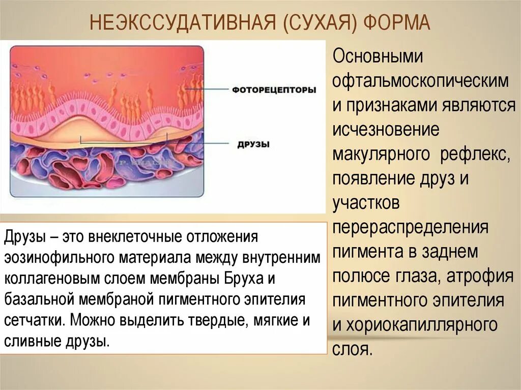 Лечение дегенерации макулы. Возрастная макулярная дегенерация патогенез. ВМД патогенез. Мембрана Бруха сетчатки. Патогенез ВМД схема.