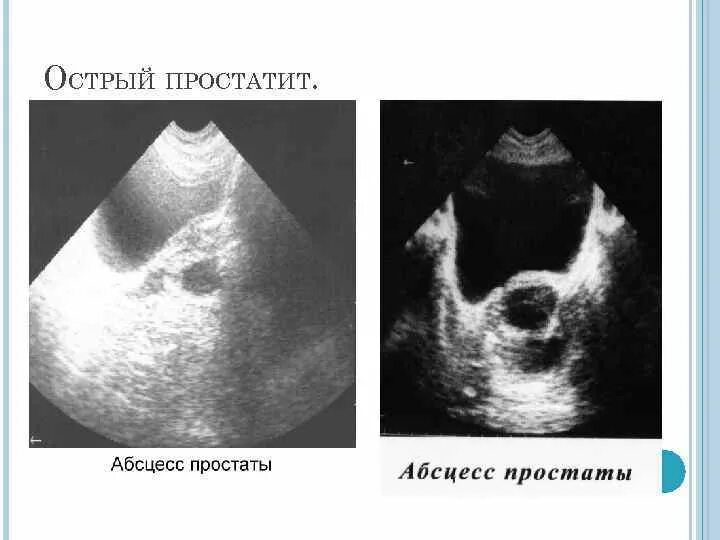 Острые простаты. Острый простатит трузи. Острый простатит УЗИ снимки.