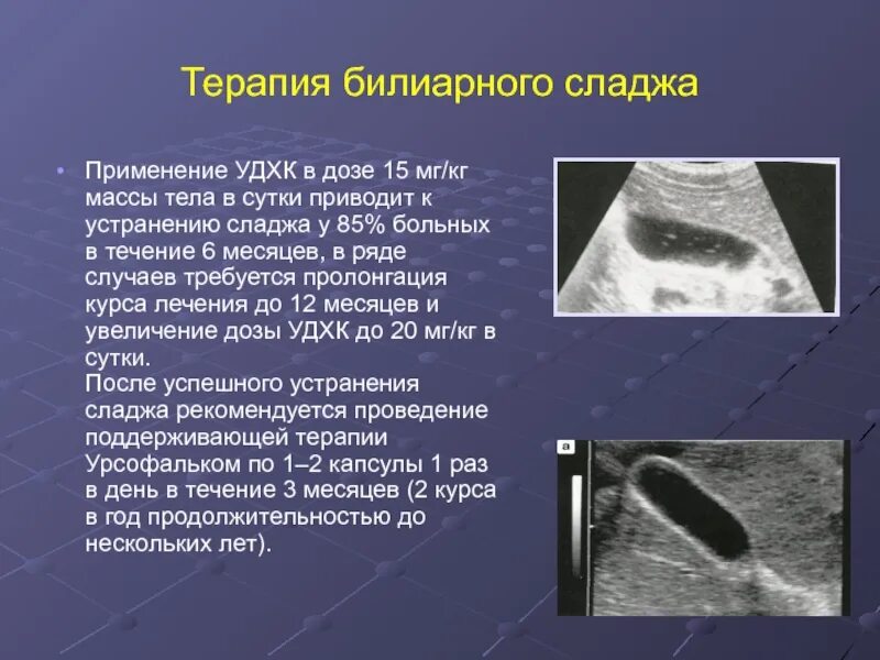 Эхогенный желчный пузырь. Сладж-синдром желчного пузыря. Сладж в желчном пузыре УЗИ.