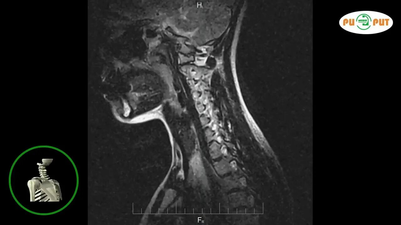 Магнитно-резонансная томография шейного отдела позвоночника. Снимки мрт шейного отдела. Мрт шейного отдела позвоночника. Мрт шейного отдела позвонка. Мрт шейного отдела позвоночника по времени