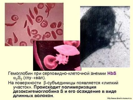 Тяжелая анемия какой гемоглобин