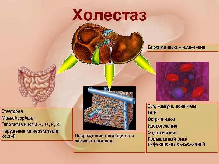 Синдром печеночного холестаза. Внутри печеночной холестаза.