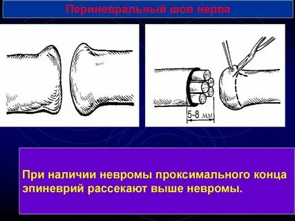 Пластика нерва