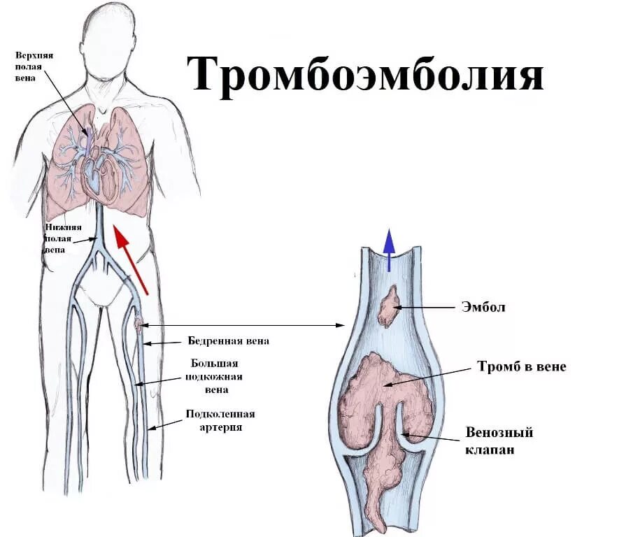 Тромбозы и эмболии артерий. Тромбоэмболия легочной артерии нижних конечностей. Тромбоэмболия нижних конечностей заболевания. Омбоэмболия лёгочной артерии. Тромбоэмболия легочной артерии (Тэла).