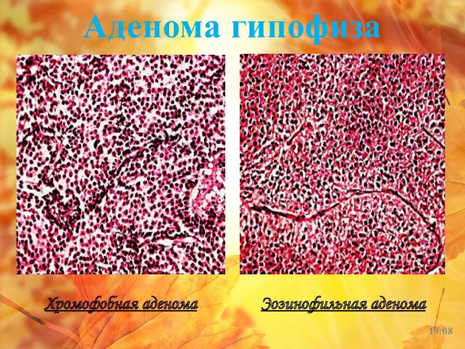 Хромофобная аденома гипофиза микропрепарат. Аденома предстательной железы гистология. Аденокарцинома предстательной железы гистология. Липецк аденома. Липецк аденома.