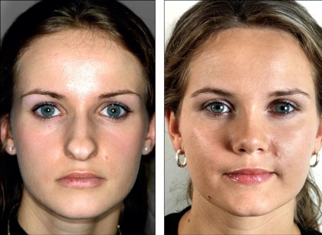 Пластическая операция со скольки лет. Ринопластика до и после. Ларингопластика до и после. Ринопластика кончика носа.