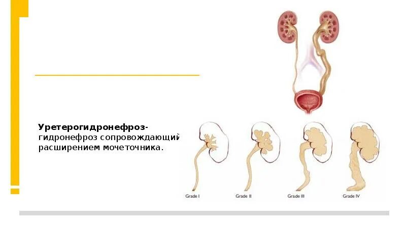 Перегиб мочеточника. Уретерогидронефроз почки. Гидронефроз левой почки 2ст. Мегауретер почки гидронефроз. Гидронефроз почки 4 степени.