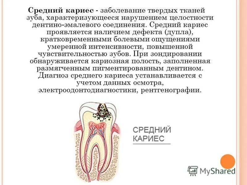Кариозная полость сообщается с полостью зуба. Диагноз средний кариес. кариозное поражение зуба.
