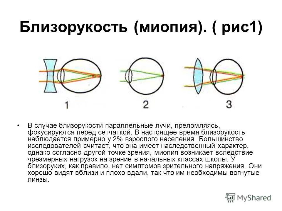 Близорукость. Близорукость миопия. Приобретенная миопия. Лучи фокусируются перед сетчаткой. Миопия что это простыми словами