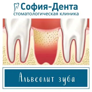 Температура неделю после удаления зуба