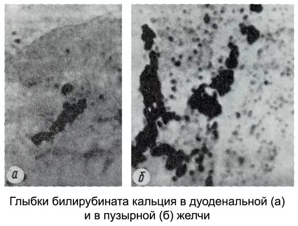 Эпителий в желчи. Микролиты в желчи микроскопия. Микроскопия желчи билирубинат кальция. Микроскопия дуоденального содержимого.