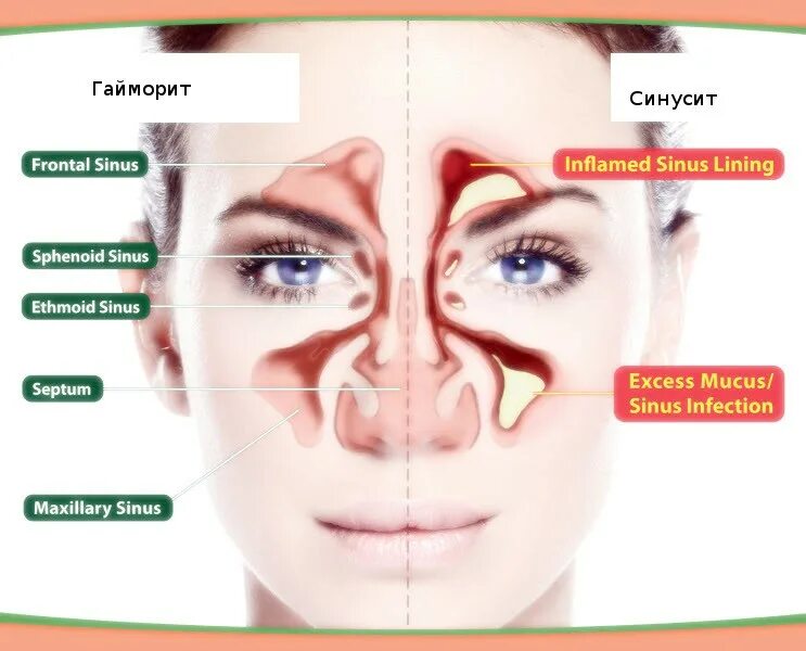 Двухсторонний гайморит. Сколько лечат гайморит