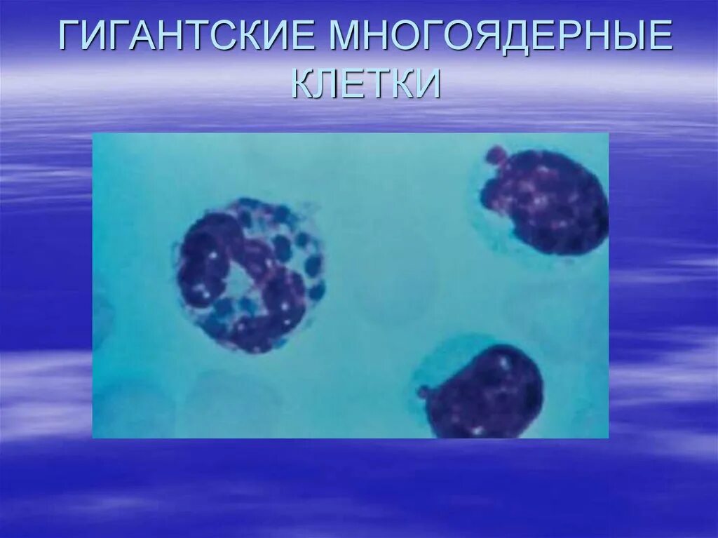 Клетка типа инородных тел. Гигантские многоядерные клетки. гигантские многоядерные клетки типа инородных тел. многоядерная клетка инородных тел. многоядерные гигантские клетки образуются из.