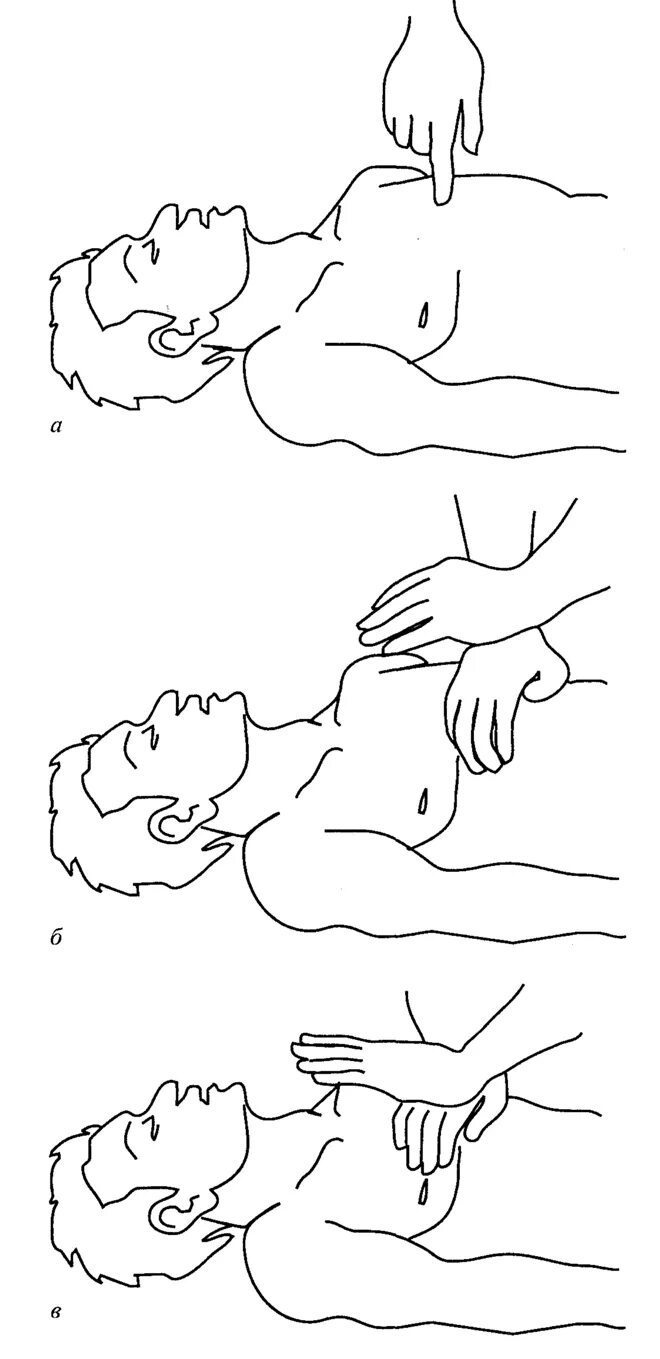 Непрямой массаж сердца техника. Техника наружного массажа сердца. Искусственное дыхание и непрямой массаж техника. Расположение рук при проведении непрямого массажа.