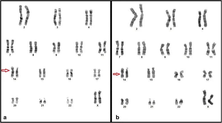 Робертсоновская транслокация хромосом. Робертсоновская транслокация 21 хромосомы кариотип. Робертсоновская транслокация кариотип 13 и 14 хромосома. Транслокация 22 хромосомы.