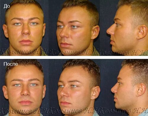 Операцию по оскоплению. Пластическая операция увеличение роста. Увеличение члена с хирургическим вмешательством. Удлинение ног до и после. Хирургическая операция.