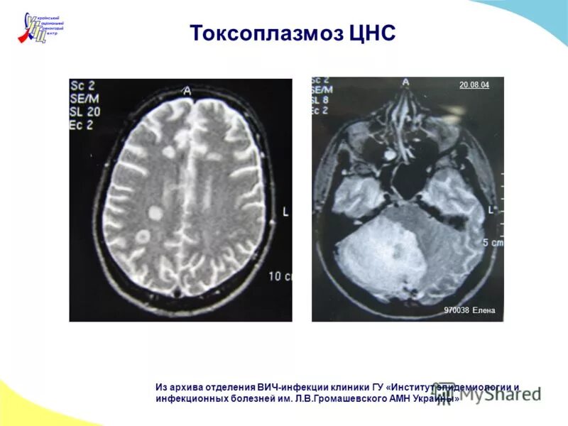 клинические симптомы, характерные для хронического токсоплазмоза. хронический приобретенный токсоплазмоз. центр токсоплазмоза. приобретенный токсоплазмоз. хронический токсоплазмоз.