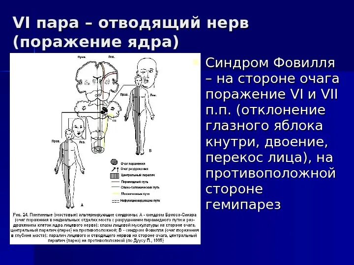 Поражение 3 нерва. Правосторонний гемипарез очаг поражения. Синдром Фовилля очаг поражения. Vi пара – отводящий нерв. Симптомы и синдромы поражения.. Центральный гемипарез справа очаг поражения.