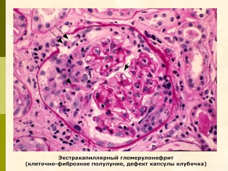 Интракапиллярный гломерулонефрит. Быстропрогрессирующий гломерулонефрит гистология. подострый гломерулонефрит макропрепарат. экстракапиллярный гломерулонефрит патанатомия. гломерулонефрит с полулуниями гистология.